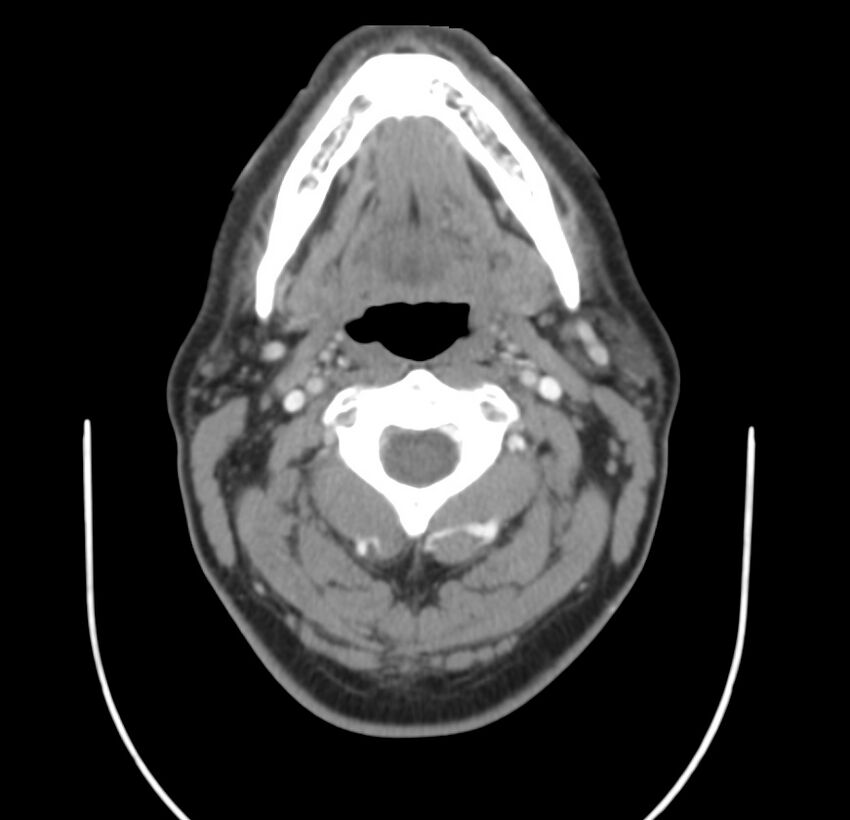 Colloid cyst of thyroid (Radiopaedia 22897-22923 Axial C+ delayed 30).jpg