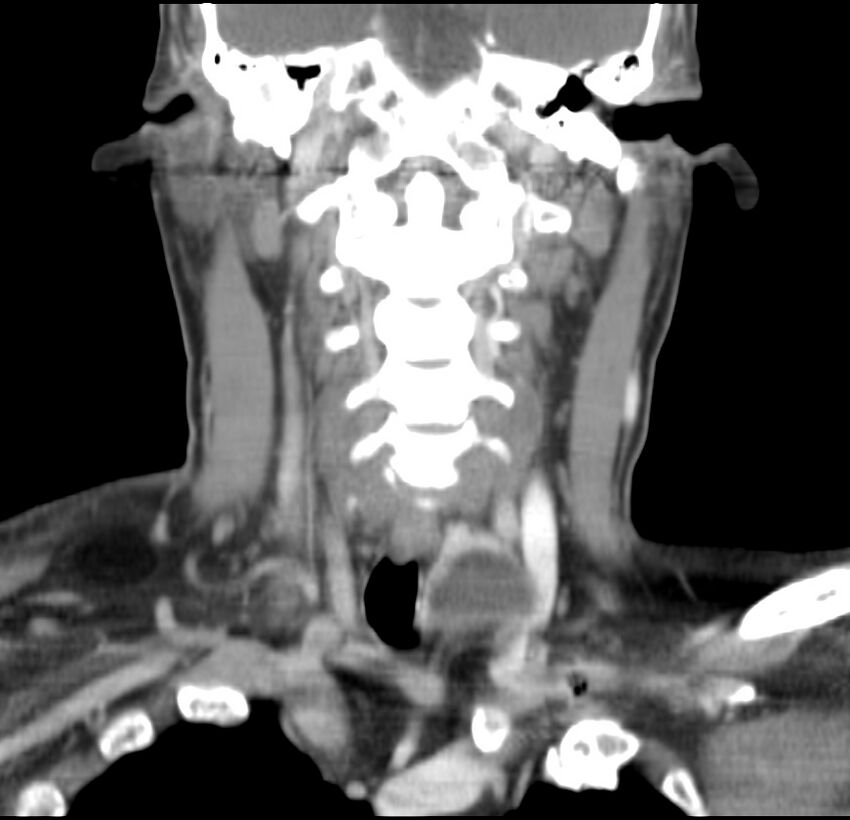 Colloid cyst of thyroid (Radiopaedia 22897-22923 Coronal C+ delayed 33).jpg