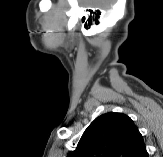 File:Colloid cyst of thyroid (Radiopaedia 22897-22923 Sagittal C+ delayed 12).jpg