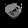 Colocolic fistula - Crohn disease (Radiopaedia 57063-63955 B 7).jpg