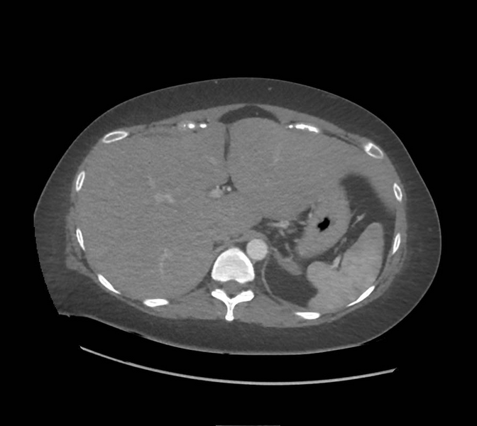 File:Colonic pseudo-obstruction (Radiopaedia 79752-92980 A 42).png