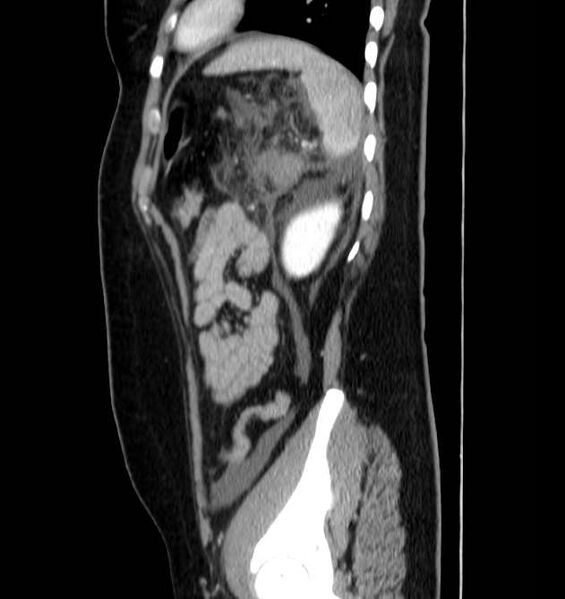 File:Necrotizing pancreatitis (Radiopaedia 23001-23031 C 65).jpg