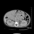 Neonatal neuroblastoma (Radiopaedia 56651-63438 Axial non-contrast 41).jpg