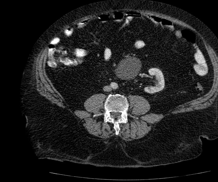 Nephroptosis with inguinal hernia containing perirenal fat (Radiopaedia 56632-63391 C 205).jpg