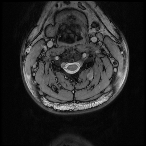 File:Neurofibromatosis type 2 (Radiopaedia 44936-48837 Axial Gradient Echo 27).png