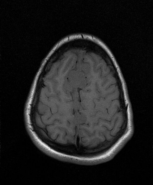 File:Neurofibromatosis type 2 (Radiopaedia 66211-75401 Axial T1 23).jpg