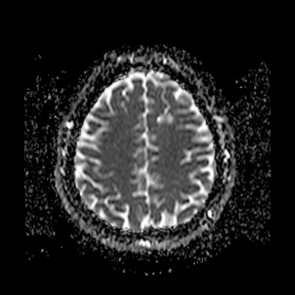 File:Neurofibromatosis type 2 (Radiopaedia 67470-76871 Axial ADC 18).jpg