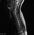 Neurofibromatosis type 2 - cranial and spinal involvement (Radiopaedia 5351-7112 Sagittal T2 6).jpg