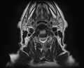 Non-Hodgkin lymphoma - parotid gland (Radiopaedia 71531-81890 Axial T2 6).jpg