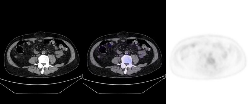 File:Non-Hodgkin lymphoma involving seminal vesicles with development of interstitial pneumonitis during Rituximab therapy (Radiopaedia 32703-33752 ax CT Fus PET 46).jpg