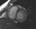 Non-compaction of the left ventricle (Radiopaedia 69436-79314 Short axis cine 157).jpg