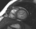 Non-compaction of the left ventricle (Radiopaedia 69436-79314 Short axis cine 98).jpg