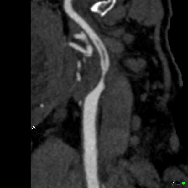 File:Non-occlusive intraluminal internal carotid artery thrombus (Radiopaedia 37751-39658 A 49).jpg