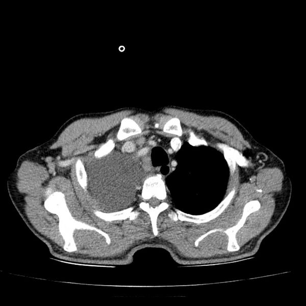 File:Non small-cell lung cancer (Radiopaedia 24467-24769 C+ delayed 12).jpg