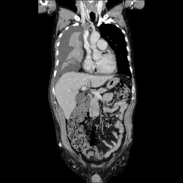 File:Non small-cell lung cancer (Radiopaedia 24467-24769 Coronal C+ delayed 23).jpg