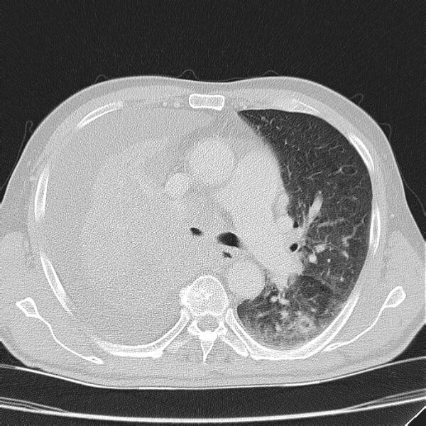 File:Non small-cell lung cancer (Radiopaedia 24467-24769 lung window 20).jpg