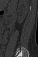 Normal CT lumbar spine (Radiopaedia 53981-60118 Sagittal bone window 88).jpg