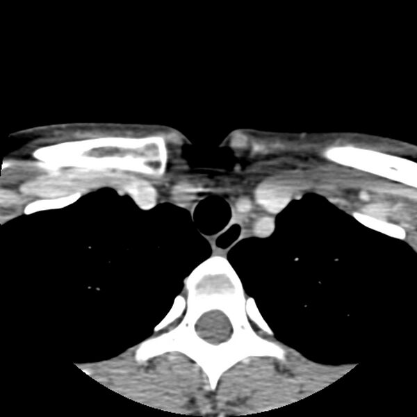 File:Normal CT of the neck (Radiopaedia 14575-14500 Axial C+ 67).jpg