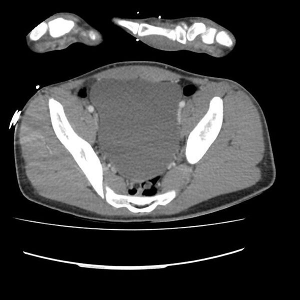 File:Normal dual-phase trauma CT chest,abdomen and pelvis (Radiopaedia 48092-52899 A 100).jpg