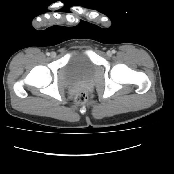 File:Normal dual-phase trauma CT chest,abdomen and pelvis (Radiopaedia 48092-52899 A 112).jpg