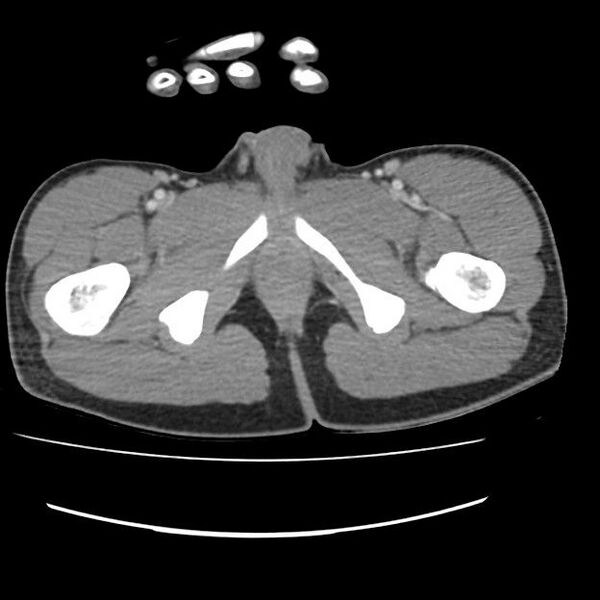 File:Normal dual-phase trauma CT chest,abdomen and pelvis (Radiopaedia 48092-52899 A 119).jpg