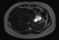 Normal liver MRI with Gadolinium (Radiopaedia 58913-66163 E 26).jpg