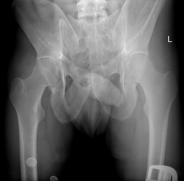 File:Normal pelvis - outlet view (Radiopaedia 45493).jpg