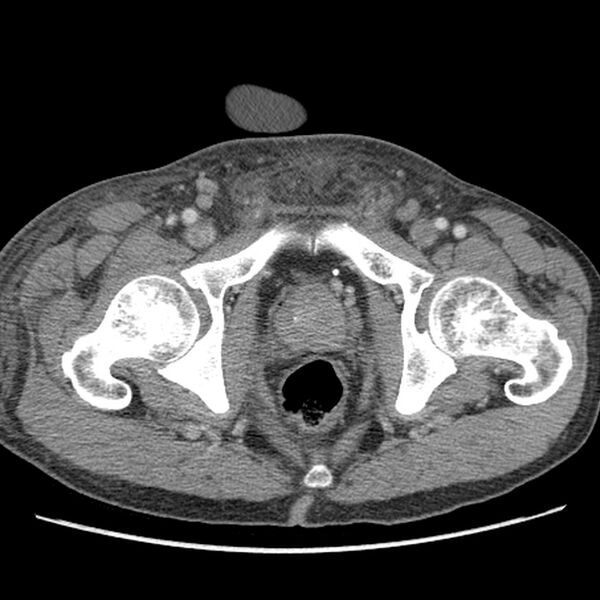 File:Obstructive bladder transitional cell carcinoma (Radiopaedia 9825-10410 A 36).jpg