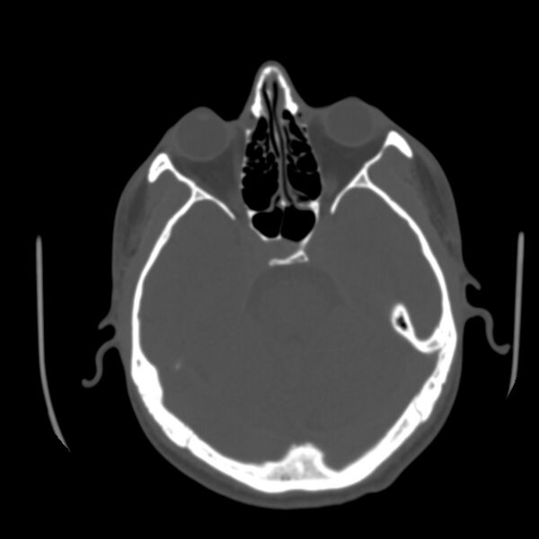 File:Occipital spur - asymptomatic (Radiopaedia 87753-104201 Axial bone window 56).jpg