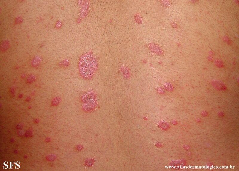 File:Psoriasis (Dermatology Atlas 149).jpg