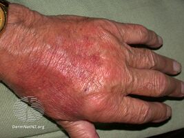 Rheumatoid arthritis skin