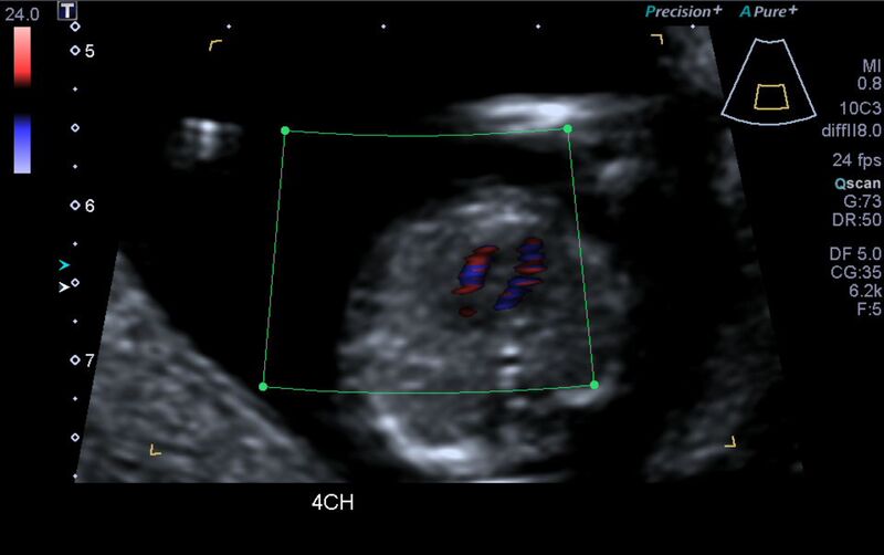 File:1st trimester nuchal-morphology ultrasound (Radiopaedia 44706-48477 Heart views cine with colour 11).jpg