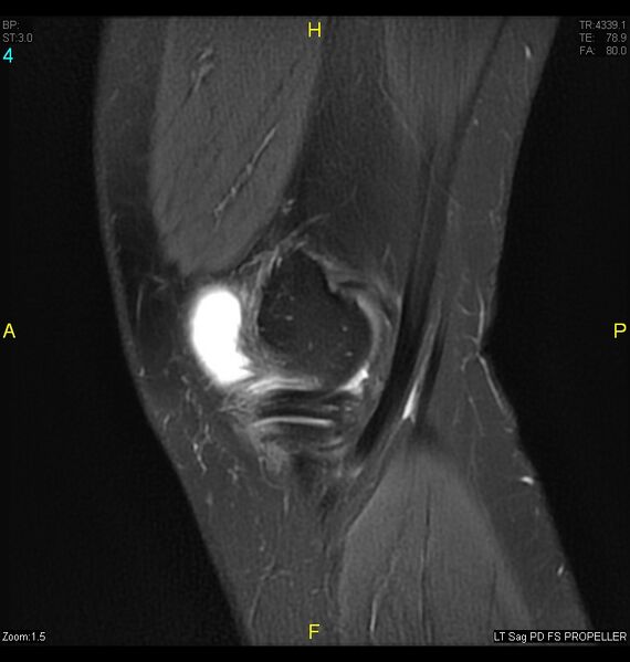 File:ACL mucoid degeration with cystic changes (Radiopaedia 48428-53341 Sagittal PD fat sat 2).jpg