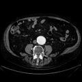 Abdominal aortic aneurysm (Radiopaedia 25855-26001 Axial C+ arterial phase 79).jpg