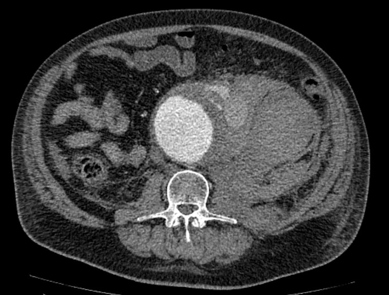 File:Abdominal aortic aneurysm rupture (Radiopaedia 54179-60362 Axial C+ arterial phase 35).jpg