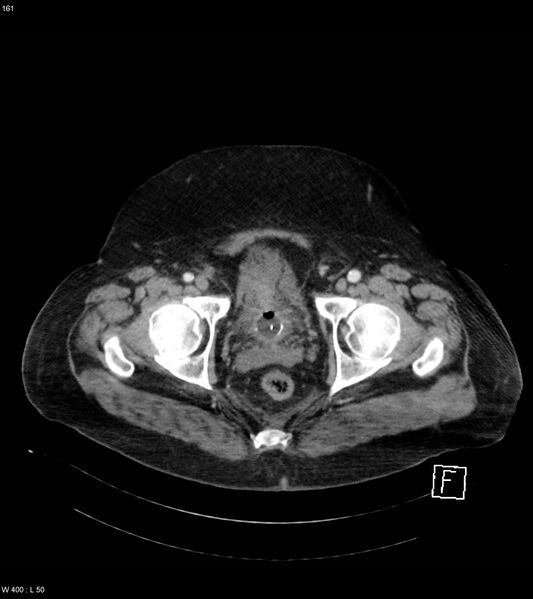 File:Abdominal aortic aneurysm with intramural hematoma then rupture (Radiopaedia 50278-55632 Axial C+ arterial phase 160).jpg