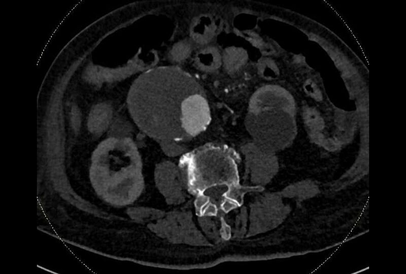 File:Abdominal aortic aneurysm with thrombus fissuration (Radiopaedia 73192-83919 Axial C+ arterial phase 113).jpg