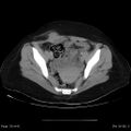 Abdominal wall endometriosis (Radiopaedia 25723-25885 Axial C+ portal venous phase 30).jpg