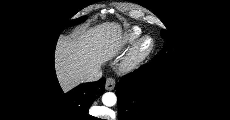 File:Aberrant left main coronary artery (ALMCA) arising from the right sinus with interarterial course (Radiopaedia 63251-71814 Axial C+ arterial phase 179).JPG