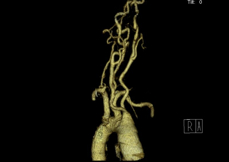 File:Aberrant right subclavian artery (Radiopaedia 19283-19294 3D reconstruction C+ arterial phase 1).jpg