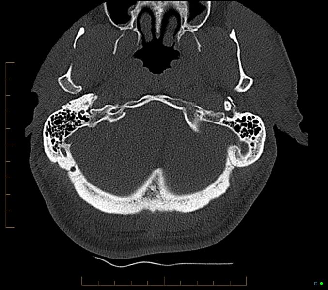 File:Accessory articulation of cervical transverse processes (Radiopaedia 82715-96933 Axial non-contrast 1).jpg