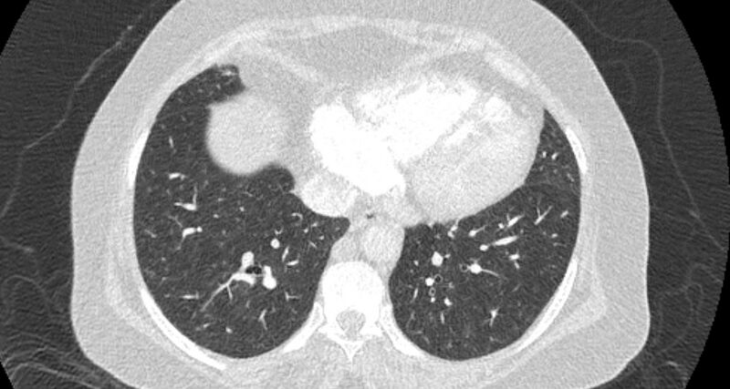 File:Accessory right inferior hepatic vein (Radiopaedia 65245-74259 Axial lung window 55).jpg