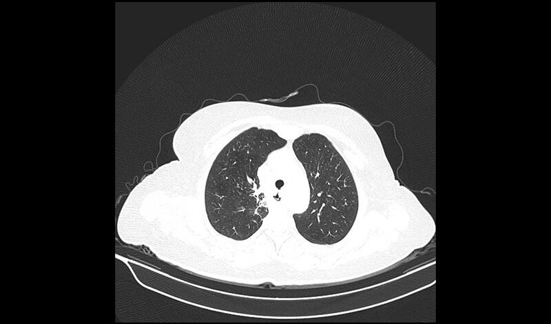 File:Acquired tracheo-esophageal fistula (Radiopaedia 51356-57103 Axial lung window 12).jpg