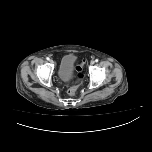File:Acute-on-chronic Crohn disease with enteroenteric fistula (Radiopaedia 66686-75987 B 74).jpg