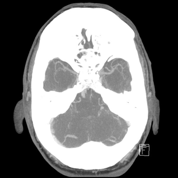 File:Acute A3 occlusion with ACA ischemic penumbra (CT perfusion) (Radiopaedia 72036-82527 Axial 10 sec delay thick MIP 11).jpg