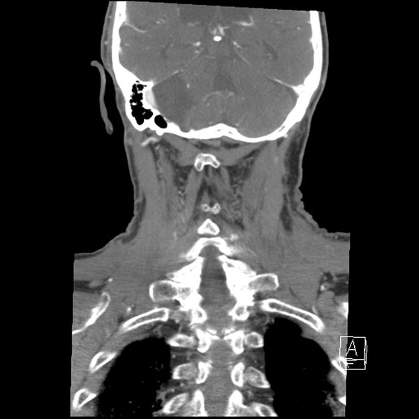 File:Acute ICA ischemic penumbra due to high-grade CCA stenosis (CT perfusion) (Radiopaedia 72038-82530 Coronal C+ arterial phase 35).jpg