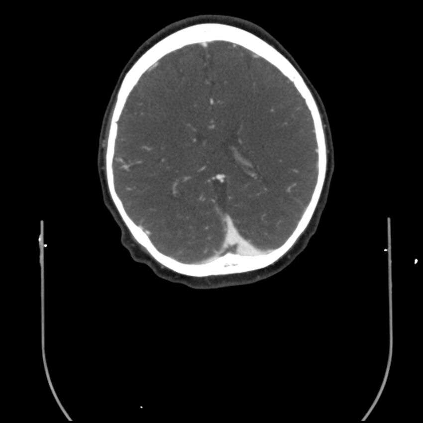 Acute M1 occlusion with ischemic penumbra (CT perfusion) (Radiopaedia 71897-82344 Axial C+ arterial phase thins 29).jpg
