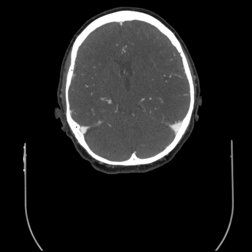 Acute M1 occlusion with ischemic penumbra (CT perfusion) (Radiopaedia 71897-82344 Axial C+ arterial phase thins 66).jpg