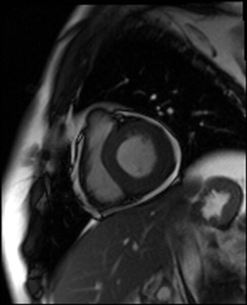 File:Acute anteroseptal myocardial infarction (Radiopaedia 68409-77944 Short axis (basal) SSFP cine 8).jpg