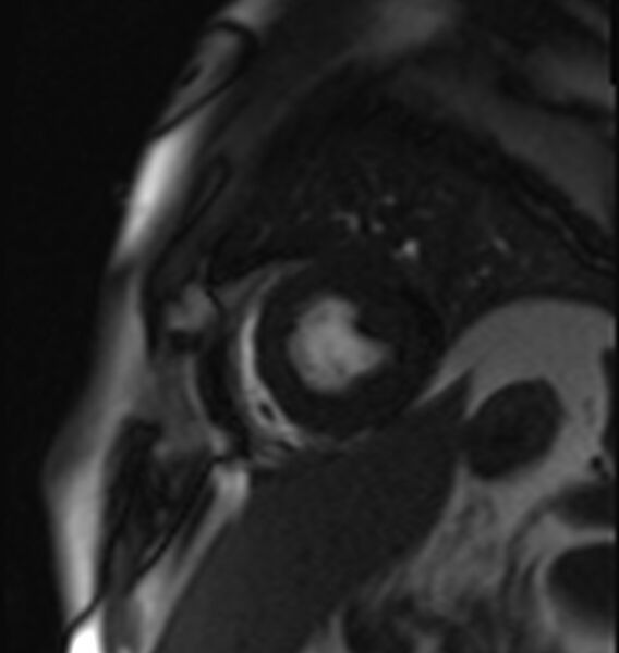 File:Acute anteroseptal myocardial infarction (Radiopaedia 68409-77945 Short axis (mid ventricular) Perfusion 8).jpg